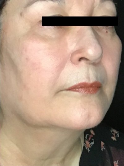 Patient #56987: Skin Tightening with Radiofrequency After Image