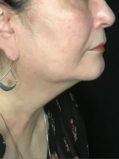 Patient #56987: Skin Tightening with Radiofrequency After Image