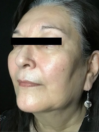 Patient #56987: Skin Tightening with Radiofrequency After Image