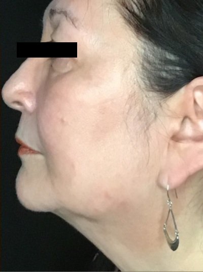 Patient #56987: Skin Tightening with Radiofrequency After Image