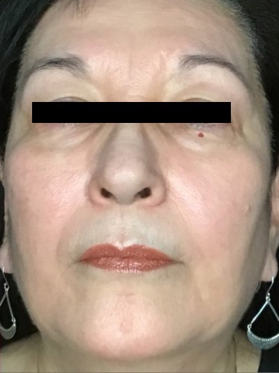 Patient #56987: Skin Tightening with Radiofrequency After Image