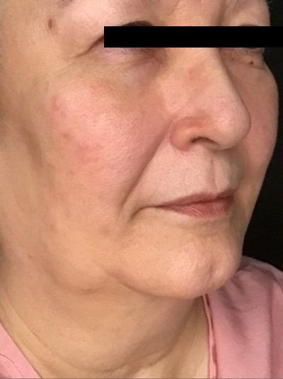 Patient #56987: Skin Tightening with Radiofrequency Before Image
