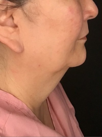 Patient #56987: Skin Tightening with Radiofrequency Before Image
