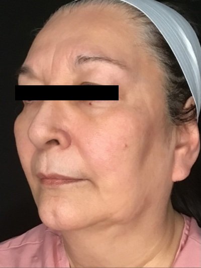 Patient #56987: Skin Tightening with Radiofrequency Before Image