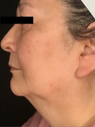 Patient #56987: Skin Tightening with Radiofrequency Before Image