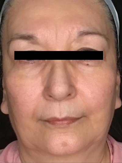 Patient #56987: Skin Tightening with Radiofrequency Before Image