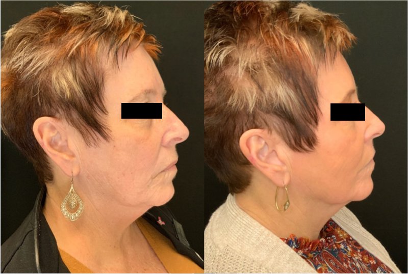 Patient #12548: Sofwave Face and Neck Combine Image