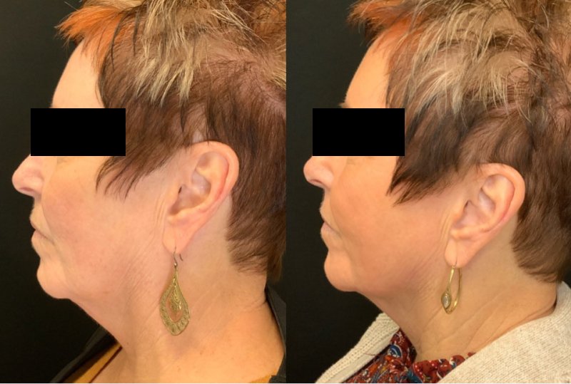 Patient #12548: Sofwave Face and Neck Combine Image