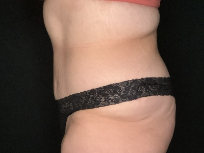 Patient #23698: Tummy Tuck with Liposuction to Flanks and Back After Image