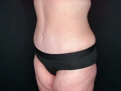 Patient #69856: Tummy Tuck with Liposuction to Flanks After Image