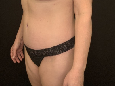 Patient #89658: Tummy Tuck with Liposuction to Flanks After Image