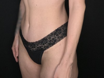 Patient #67891: Tummy Tuck After Image