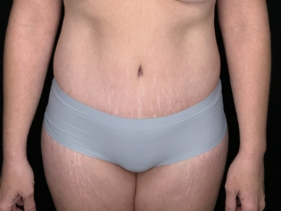 Patient #96587: Tummy Tuck with Liposuction to Flanks After Image
