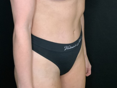 Patient #56985: Tummy Tuck with Flank Liposuction After Image