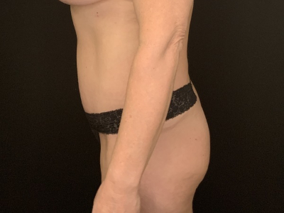 Patient #89658: Tummy Tuck with Liposuction to Flanks After Image