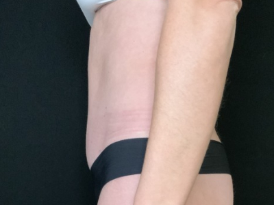 Patient #12339: Tummy Tuck After Image