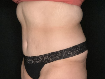 Patient #23698: Tummy Tuck with Liposuction to Flanks and Back After Image