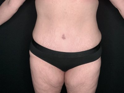 Patient #69856: Tummy Tuck with Liposuction to Flanks After Image