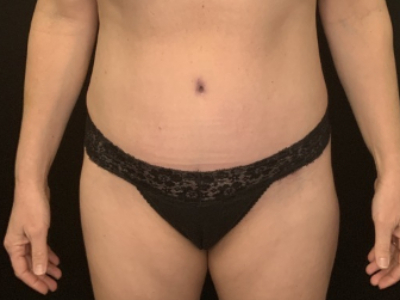Patient #89658: Tummy Tuck with Liposuction to Flanks After Image