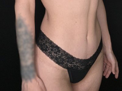 Patient #67891: Tummy Tuck After Image