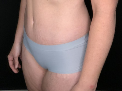 Patient #96587: Tummy Tuck with Liposuction to Flanks After Image