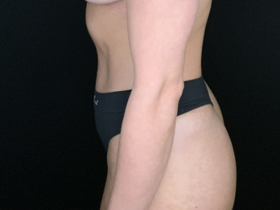 Patient #56985: Tummy Tuck with Flank Liposuction After Image