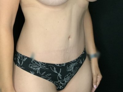 Patient #45696: Tummy Tuck After Image