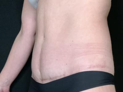 Patient #12339: Tummy Tuck After Image