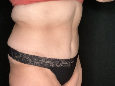 Patient #23698: Tummy Tuck with Liposuction to Flanks and Back After Image