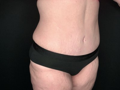 Patient #69856: Tummy Tuck with Liposuction to Flanks After Image