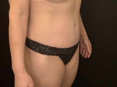 Patient #89658: Tummy Tuck with Liposuction to Flanks After Image