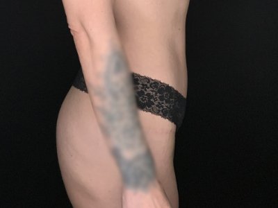 Patient #67891: Tummy Tuck After Image