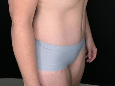 Patient #96587: Tummy Tuck with Liposuction to Flanks After Image