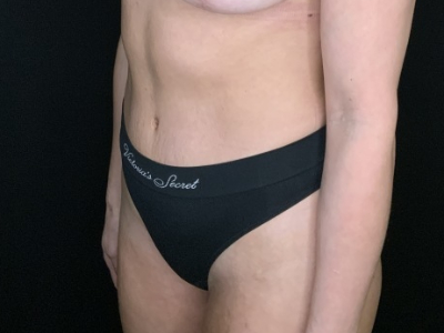 Patient #56985: Tummy Tuck with Flank Liposuction After Image