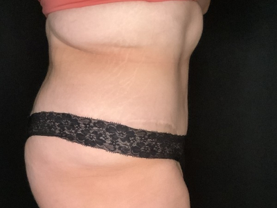 Patient #23698: Tummy Tuck with Liposuction to Flanks and Back After Image