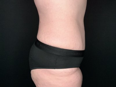 Patient #69856: Tummy Tuck with Liposuction to Flanks After Image