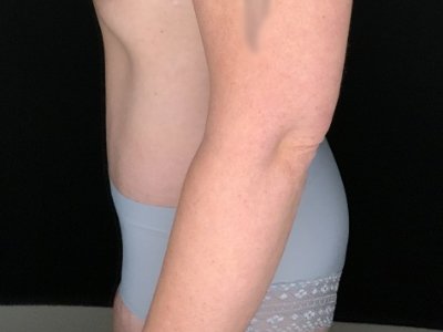 Patient #96587: Tummy Tuck with Liposuction to Flanks After Image