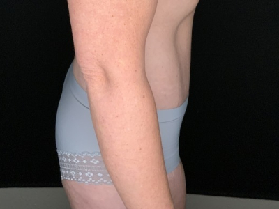 Patient #96587: Tummy Tuck with Liposuction to Flanks After Image