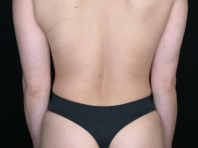 Patient #56985: Tummy Tuck with Flank Liposuction After Image