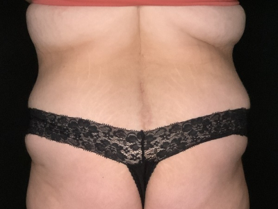 Patient #23698: Tummy Tuck with Liposuction to Flanks and Back After Image