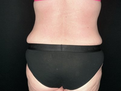 Patient #69856: Tummy Tuck with Liposuction to Flanks After Image