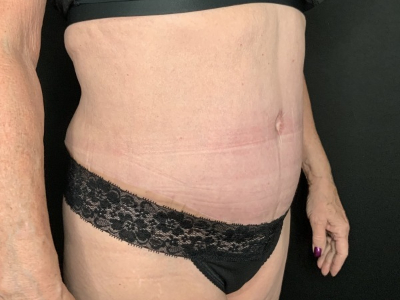Patient #45698: Tummy Tuck with Liposuction to Flanks, Hips, and Abdomen After Image