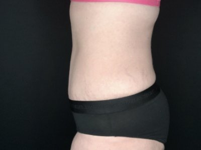 Patient #69856: Tummy Tuck with Liposuction to Flanks After Image