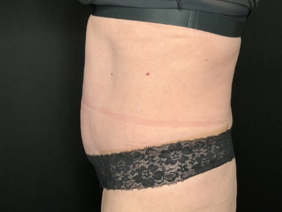 Patient #45698: Tummy Tuck with Liposuction to Flanks, Hips, and Abdomen After Image