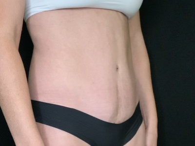 Patient #12339: Tummy Tuck After Image