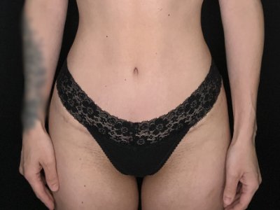 Patient #67891: Tummy Tuck After Image