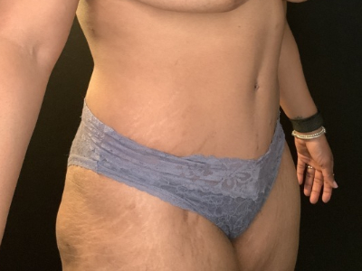 Patient #78963: Tummy Tuck with Liposuction to Flanks After Image