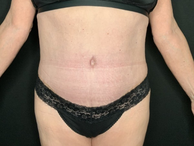 Patient #45698: Tummy Tuck with Liposuction to Flanks, Hips, and Abdomen After Image