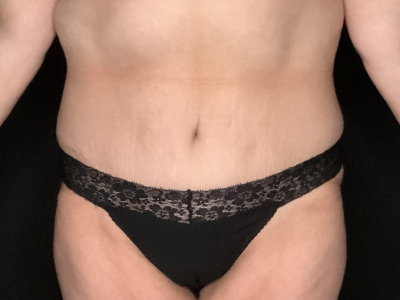 Patient #23698: Tummy Tuck with Liposuction to Flanks and Back After Image