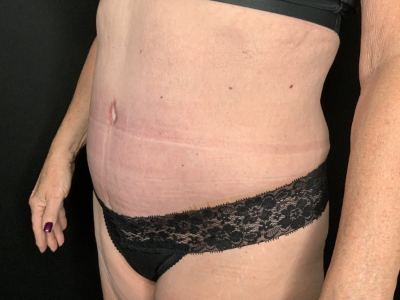 Patient #45698: Tummy Tuck with Liposuction to Flanks, Hips, and Abdomen After Image
